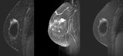 MRI shows an invasive ductal carcinoma abutting an implant in a 58-year-old woman with a palpable mass and retroglandular saline implants for 30 years. There is a spiculated mass abutting the superolateral implant. An outside mammogram and ultrasound failed to show the carcinoma.