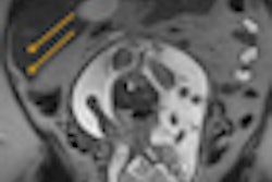 2013 04 26 10 30 32 837 Mri Appendicitis 70