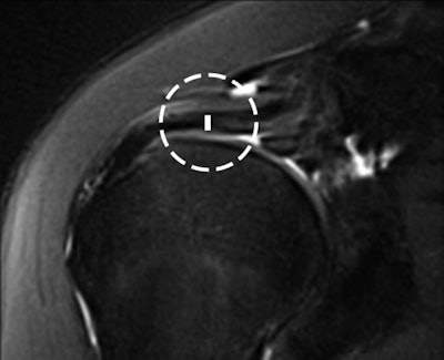 Cable thickness was measured from its superior to inferior margins (circle).
