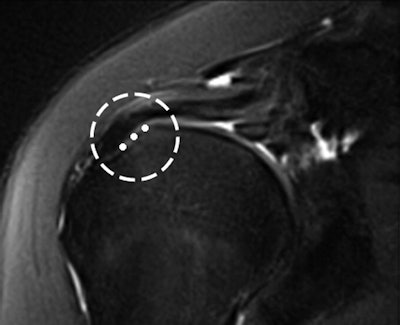 The location of the cable was measured from medial enthesis to its lateral margin (circle) All images courtesy of AJR.