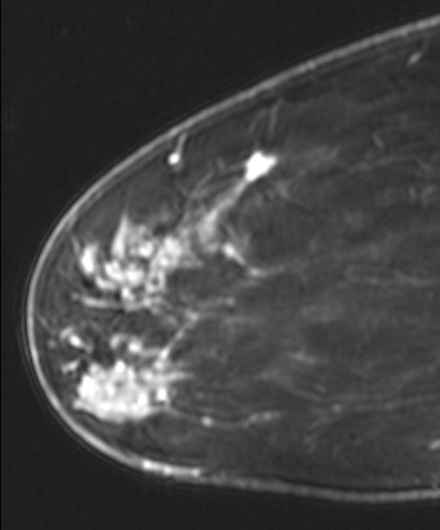 MRI shows a new lesion found superiorly in the breast. The lesion was subsequently biopsied, revealing another focus of invasive ductal carcinoma.