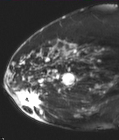Known subareolar invasive ductal carcinoma as seen on sagittal MRI. All images courtesy of Dr. Stamatia Destounis.