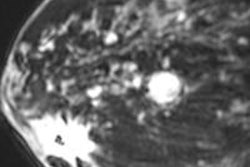 2013 05 02 14 26 04 586 Destounis Breast Mri Image A 400 20130502213620