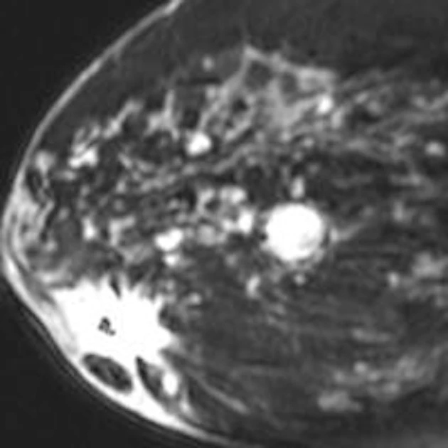 Breast MRI changes cancer treatment in many women over 60 | AuntMinnie