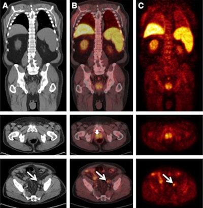 C-11 acetate CT (A), PET/CT (B), and PET (C) images of a patient with prostate cancer and unsuspected lymph-node metastasis. Diffusely increased C-11 acetate uptake was noted within the prostate gland and was most intense in the right lobe (maximum standardized uptake value, 8.4; short arrow). Long arrows indicate a normal-sized left external iliac lymph node, which harbored metastatic disease. Images courtesy of JNM.