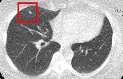 Lung cancer is clearly visible in the ultralow-dose CT image above but cannot be seen in the chest radiograph of the same patient below. All images courtesy of Dr. Waël Hanna.