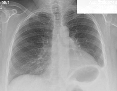 Lung cancer x-ray