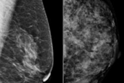 2013 05 06 10 55 22 338 Breast Density 200