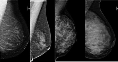 The four tissue types from left to right: almost entirely fat, scattered fibroglandular densities, heterogeneously dense, and extremely dense. The new California law applies to the last two, heterogeneously or extremely dense. Fewer than 10% of patients will have an extremely dense pattern. Image courtesy of Dr. Haydee Ojeda-Fournier.
