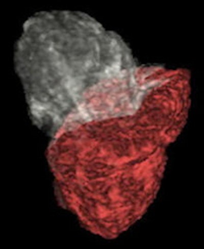 3D model of uterine corpus (white color) and cervical cancer (red color) after reconstruction of a 3D T2-weighted sequence.