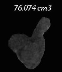 Calculated volume of cervical tumor. All images courtesy of Dr. Olga Kalinkin, PhD.