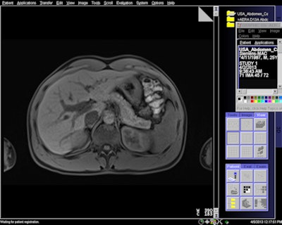MR image acquired with 7-sec breath-hold with Siemens' CAIPIRINHA software.