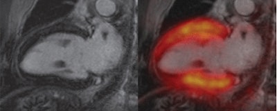 Two-chamber views show 'stunned myocardium' in a 66-year-old patient with ST-elevation myocardial infarction and acute occlusion of the left anterior descending artery. Cardiac PET/MRI was performed seven days after intervention. Late gadolinium-enhanced image (top left) shows no infarction zone. Fused late gadolinium-enhanced and PET images (top right) show that tracer uptake was reduced in segments 13-15 and 17. T2-weighted MR image (bottom left) shows myocardial edema (arrows) that corresponded well with the area of reduced tracer uptake on the bottom right image. All images courtesy of Radiology.
