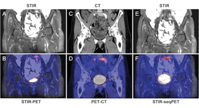 Bladder of a 65-year-old female patient. Images illustrate improved alignment with simultaneous PET/MRI (A, coronal STIR; B, fused images) compared to sequential PET/CT (C, coronal CT; D, fused images) and retrospective fusion of PET and MRI (E, coronal STIR; F, fused images). Images courtesy of Radiology.