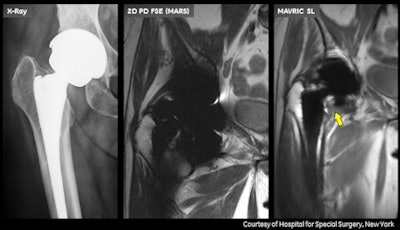 MR images show frontal (left) and cross-sectional (center) views of a patient with a hip implant. MAVRIC SL (right) visualizes the soft tissue around the implant.