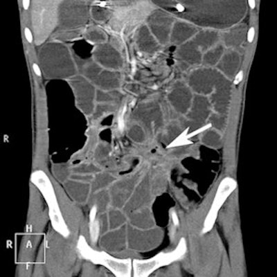 CTE coronal image of a patient with Crohn's disease. Value of CTE due to volume challenge is illustrated with fibrostenosing disease with fistulation. This can easily be missed on a nonvolume-challenged study.