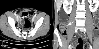 CT enteroclysis (CTE) axial and coronal images of a patient with Crohn's disease. Axial image demonstrates active inflammatory changes of terminal ileum with hyper enhancement. An added benefit of the South African authors' CTE technique is that it's possible to fill the colon with negative contrast, as can be demonstrated on the coronal image with active inflammatory changes of the cecum and ascending colon. All images courtesy of Dr. Braham van der Merwe.