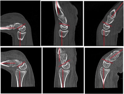 These images show the complex interaction of the lunate of the wrist in midcarpal instability. Points of extreme flexion and extension and the midpoint of that motion are shown in a normal wrist (top images) and abnormal wrist (bottom images). This trigger-lunate motion abnormality, featuring abrupt cessation and recommencement of flexion/extension, had not been previously recognized radiographically as a feature of midcarpal instability, according to the researchers.