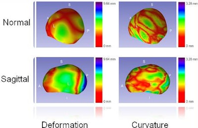 The automated CAD system's ability to display skull deformation and curvature discrepancy demonstrates its potential to better quantify and visualize abnormalities in craniosynostosis. Image courtesy of Dr. Nabile Safdar.