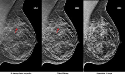 Left, 3D tomosynthesis image slice; middle, C-View 2D image; right, conventional 2D image. Images courtesy of Hologic.