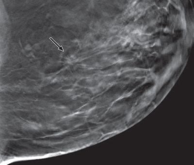 Digital mammo versus tomo