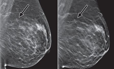 Mediolateral oblique images for digital mammography (left) and tomosynthesis (right). All tomosynthesis images show improved visibility of cancer (arrow) and cancer margins compared with digital mammography.