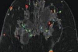 2013 05 23 16 33 59 971 With Cad Breast Mri 02 450 20130523233703