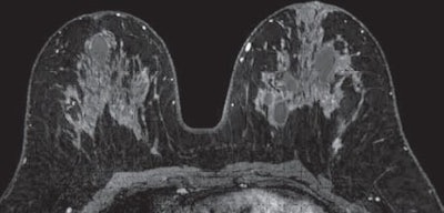 MRI of a 47-year-old woman with invasive ductal carcinoma. Initial axial contrast-enhanced MR images without CAD (above) and with CAD (below) show enhancing mass in left posterior lateral breast that is more evident with CAD color overlay. Images courtesy of AJR.