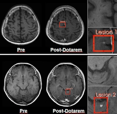 Images show two lesions in a 41-year-old woman with hemangioblastoma disease, acquired on 3-tesla MRI. Images at left are precontrast; images at right are after Dotarem administration. Image courtesy of Guerbet.
