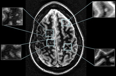 White-matter attenuated imaging was proficient in depicting MS lesions in various regions of the brain.