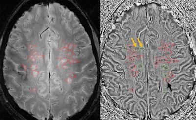 Some lesions are only seen on 7-tesla SWI phase images (yellow arrows), with lesions appearing as dark rings or with bright centers (red circles) in both SWI magnitude and phase images.