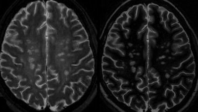 In this comparison, 7-tesla WHAT (right) shows better lesion contrast and indicates how lesions are associated with small veins, compared with the white matter depicted by 7-tesla GRASE (left). All images courtesy of Dr. Steffen Sammet, PhD.