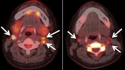 Images are from a 40-year-old woman with elevated thyroglobulin levels seven months after total thyroidectomy for papillary thyroid cancer. FDG-PET/CT (left) and FLT-PET/CT (right) scans show increased FDG uptake and FLT uptake corresponding to lymph nodes (arrows) in bilateral upper jugular areas. Physiologic increased uptake of FDG is also noted in bilateral sublingual glands (left). Images courtesy of Radiology.