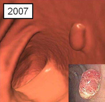 Advanced histologies