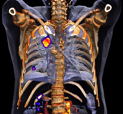Biograph mCT Flow is designed for routine use of HD-Chest motion management techniques that enable delineation and quantification of small lesions. Image courtesy of University of Tennessee, Knoxville.