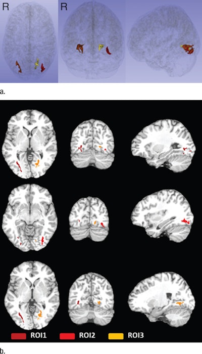 Three regions of interest (ROI) in the temporo-occipital white matter detected by the initial voxelwise linear regression of estimated prior 12 months of heading on franctional anisotropy (FA), shown as color regions rendered in 3D images (a) and superimposed on T1-weighted axial (left), coronal (middle), and sagittal (right) images from the Montreal Neurological Institute template (b). FA at each ROI was significantly lower as a function of greater heading exposure. Image courtesy of RSNA.