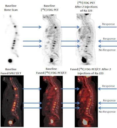 Images obtained after two injections of radium-223 dichloride show a significant decrease in FDG uptake in multiple bone metastases located in the thoracic and lumbar spine, indicating a partial metabolic treatment response at the level of the tumor cells. Images courtesy of SNMMI.