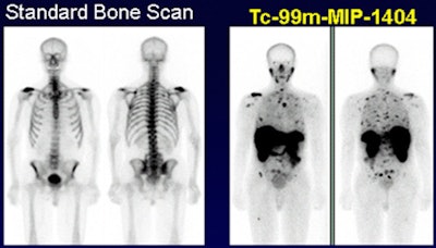 Images show prostate cancer is much more visible with Tc-99m MIP-1404 (right) than with a standard bone scan (left). Images courtesy of SNMMI.
