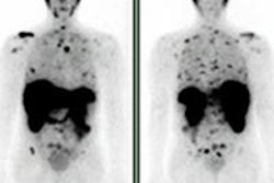 2013 06 11 17 05 49 101 Snmmi Prostate Mip1404 450 20130612000736