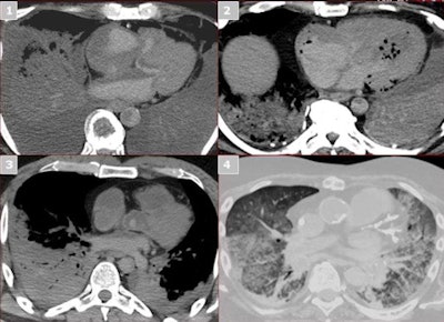 Normal postmortem findings include red blood cell sedimentation in the heart (1), gas formation (2), clot in the heart (3), and lung changes (4).