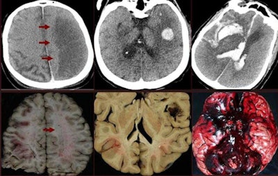 Postmortem CT images show cerebral hemorrhage, hemorrhagic metastasis, and intracranial hemorrhage.
