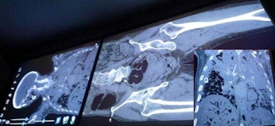 Postmortem air inside the body can be detected prior to dissection.