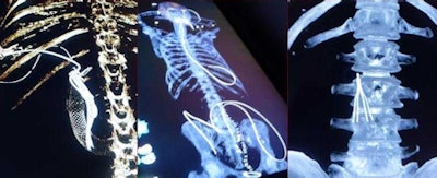 Postmortem imaging allows tubes and lines as well as internal instruments to be located prior to autopsy.