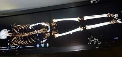 Single-click multiplanar and volume-rendered images help in the evaluation of bony deformities and findings. All images courtesy of Dr. Sarvenaz Pourjabbar.