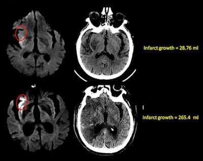 Diffusion-weighted MRI (left) and follow-up MDCT (right) of two stroke patients with similar infarct volumes; the only major difference was in involvement of the insula. The patient shown in the top row of images had no insular involvement; the patient shown in bottom row had full involvement of the anterior insula. Two-day follow-up with CT (right images) showed that infarct volume had grown by only 28.76 mL in the patient without insular involvement (top right), but infarct growth reached 265.4 mL in the patient with involvement of the anterior insula (bottom right). All images courtesy of Dr. Michael Lev.
