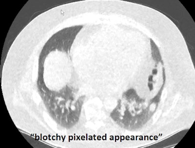 Ultralow-dose CT image of the lungs reconstructed with MBIR looks blotchy and pixelated, but small nodules can still be found.