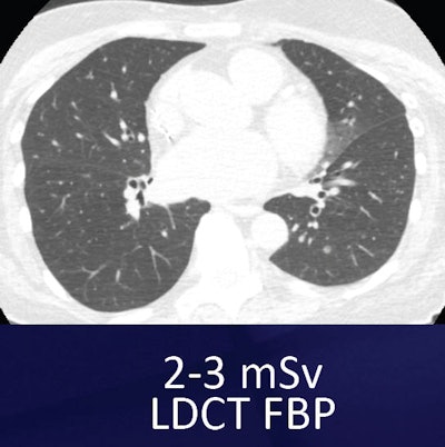 Small nodule in left lung base can be seen both in the standard low-dose filtered back projection (FBP) technique (above) and the ultralow-dose MBIR technique (below). However, the images look inherently different, which may take some getting used to. All images courtesy of Dr. Ella Kazerooni.