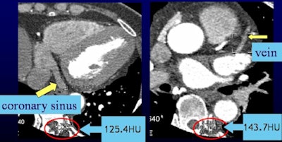 Above, more volume of contrast agent in group A resulted in more enhancement of the coronary sinus and veins. Conversely, below, less volume of contrast agent in group C resulted in less enhancement.