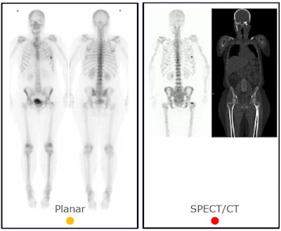 spect bone scan