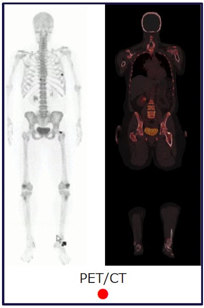 PET/CT for bone metastases